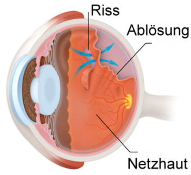Schema Netzhautablösung