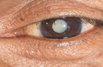 Der Graue Star (Katarakt) und Altersweitsichtigkeit